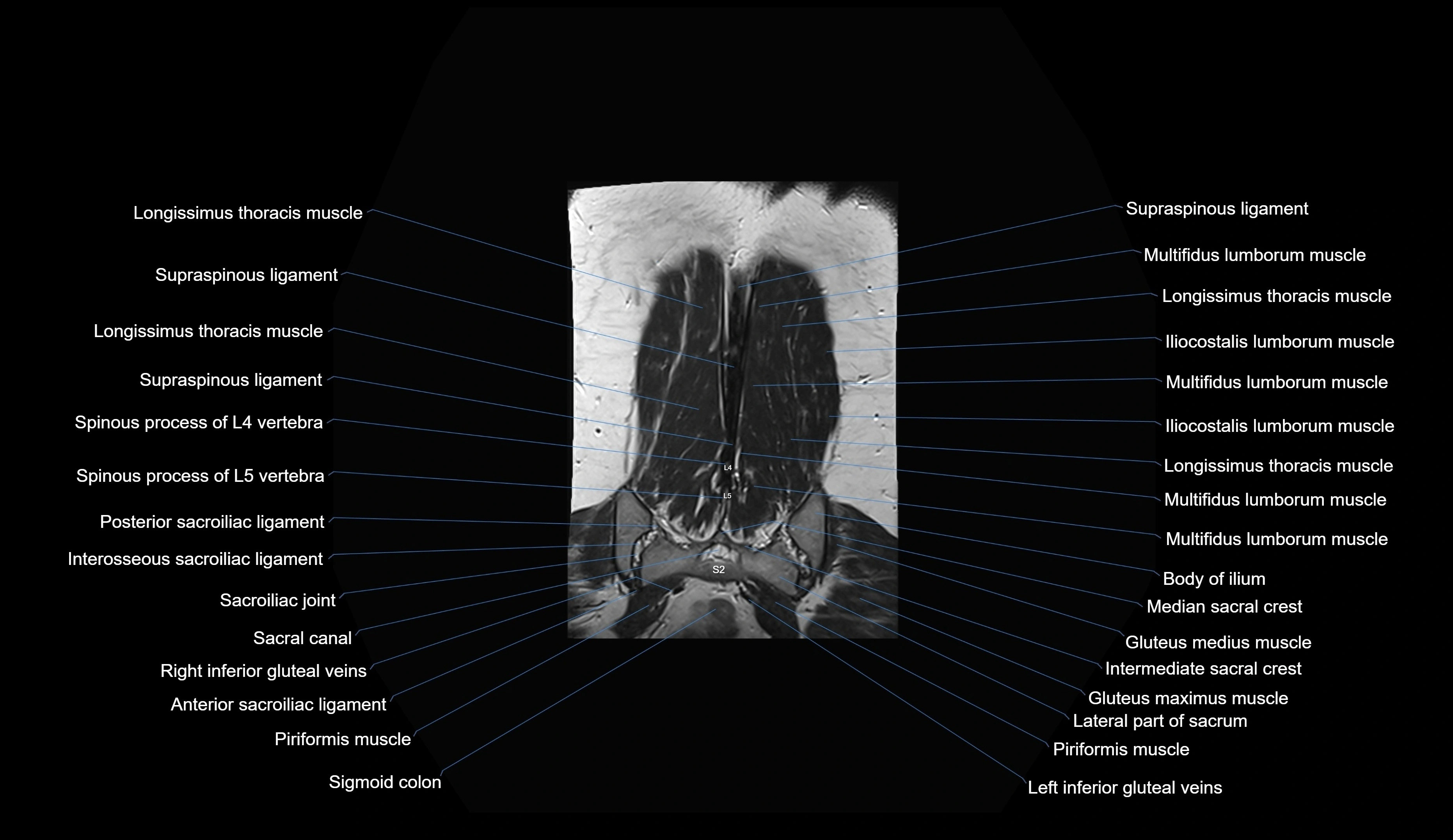 MRI lumbar spine coronal cross sectional anatomy 3T radiology  image-img-00001-00034.webp